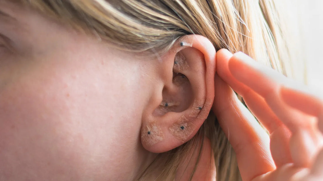 I Tried Ear Seeding for Anxiety Relief: Here’s My Honest Take