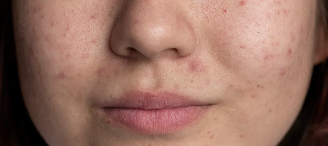 What Causes Uneven Skin Texture and How to Treat It
